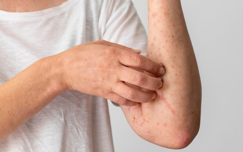 Вспышка кори в Монголии: подтверждено более 500 случаев заражения